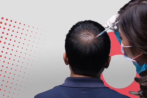 HEALING POWER OF PRP IN HAIR Platelet-rich plasma or PRP is defined as a certain amount of blood taken from the body, processed and injected into...