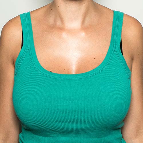 breast reduction surgery price