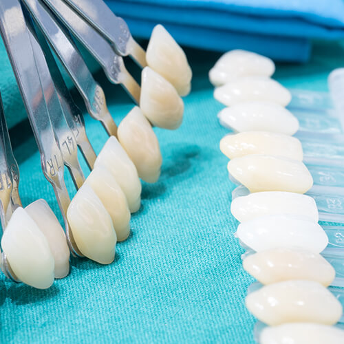Faccette dentali in porcellana Prezzi 2021