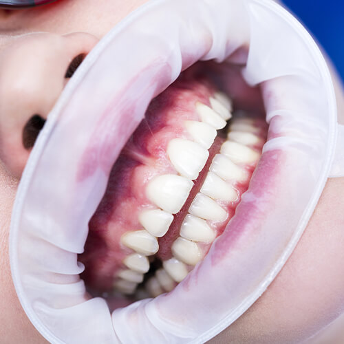 Sbiancamento dentale permanente
