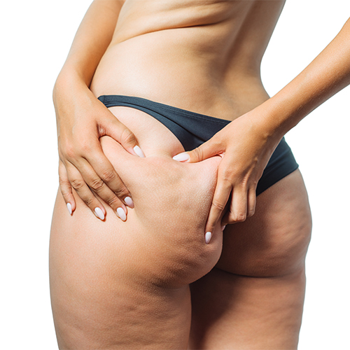 How does cellulite pass 2021